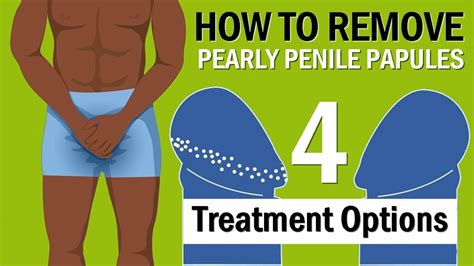 penile pearly papules men